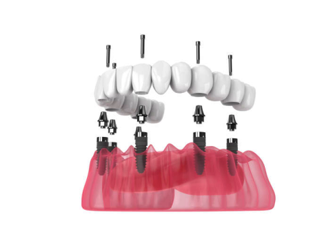 Mostički in prevleke